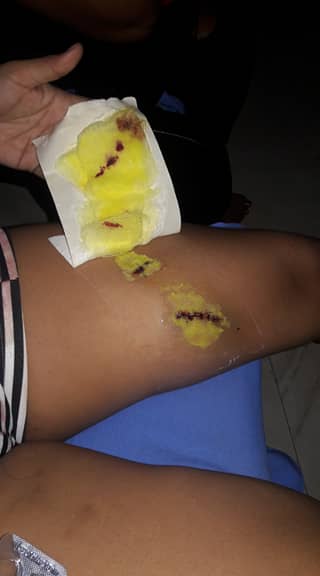 Lesiones que presuntamente sufrió la pareja de Leo Fénix.