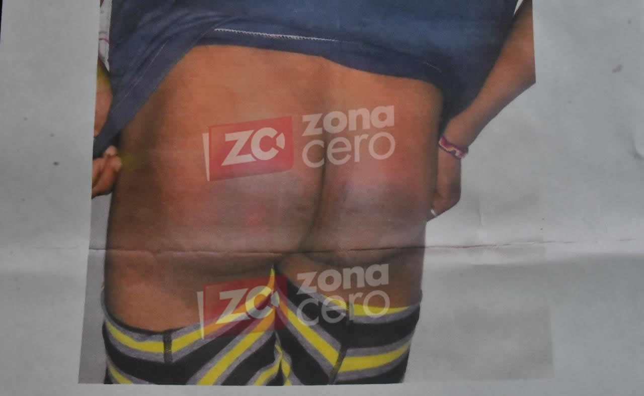 Así le quedaron los glúteos al adolescente tras la agresión a 'tablazos' que recibió dentro de la Estación de Policía del barrio El Bosque.