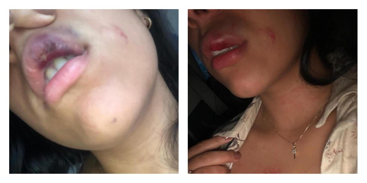 Nahomis Viana muestra la marca de los golpes recibidos