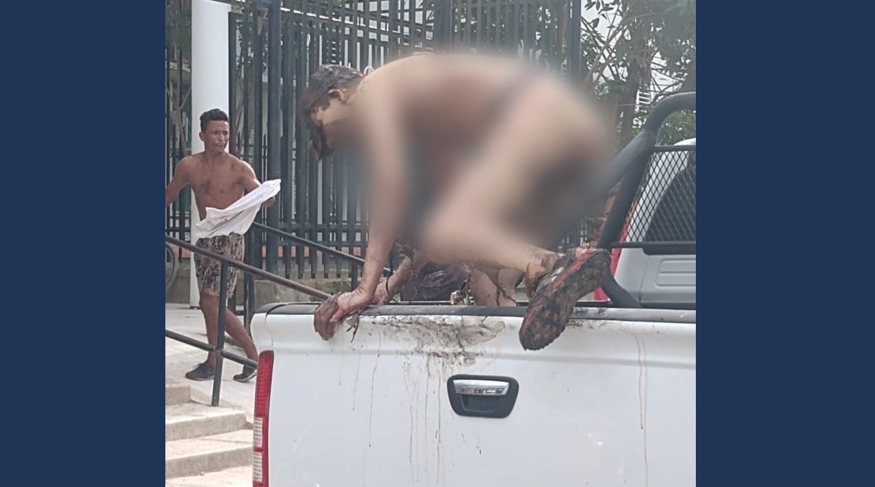 Este joven quedó con quemaduras en su cuerpo.