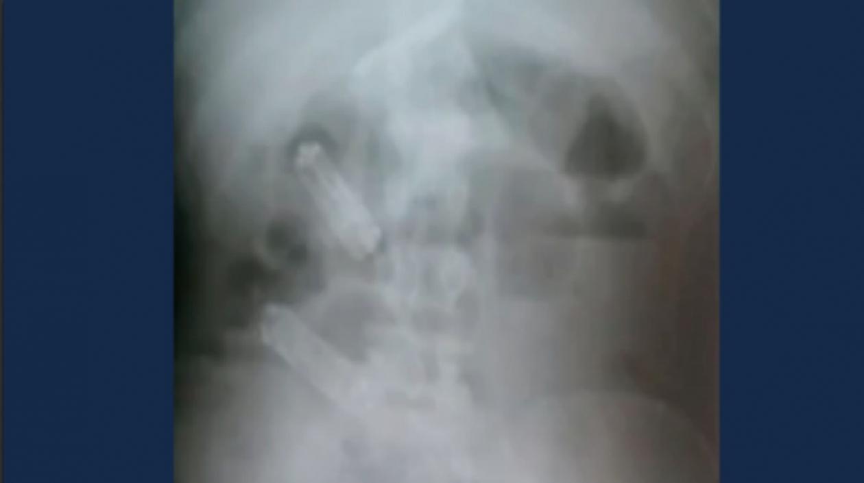 En la imagen de este rayos X se observan los celulares en el estómago del recluso.