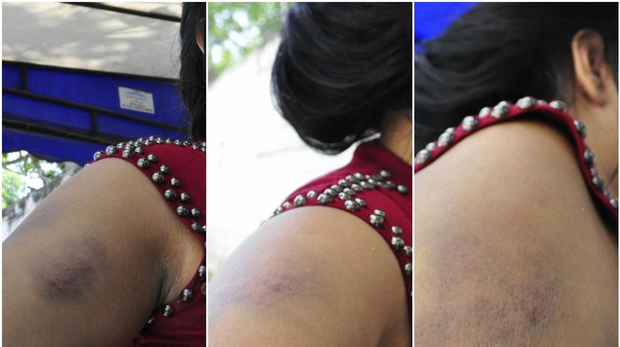 La mujer muestra los golpes recibidos.