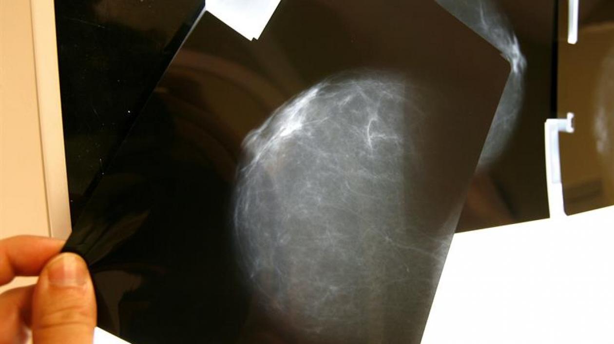 Detectado a tiempo el cáncer de seno es curable hasta en un 98 % de los casos.