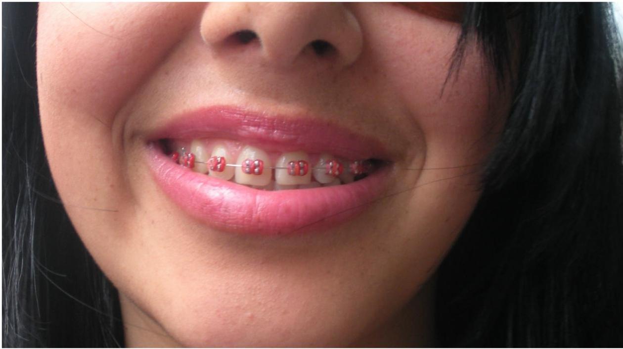Imagen para ilustrar nota sobre brackets callejeros.