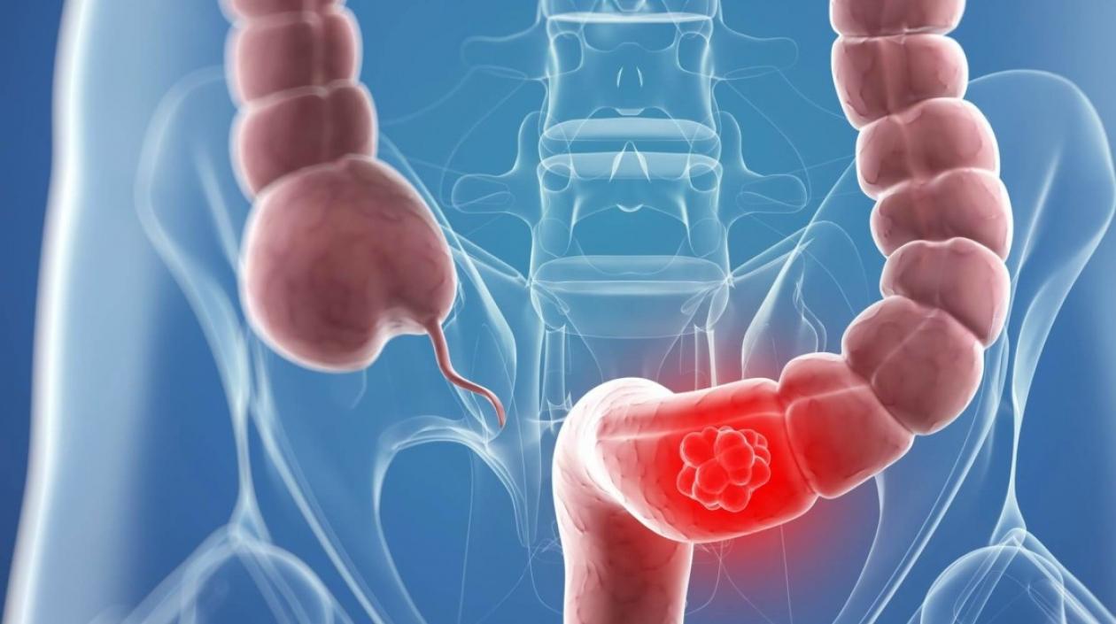 Todavía no está demostrado los vínculos directos entre nutrientes, inflamación y cáncer colorrectal.