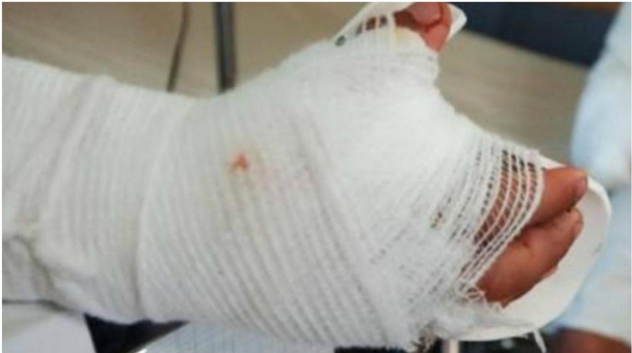 Gobierno hace llamado a disminuir las cifras de lesionados por pólvora.