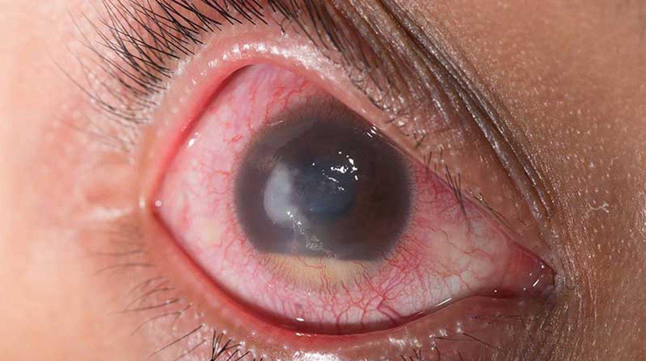 El glaucoma es silencioso por eso muchas veces no se detecta a tiempo.