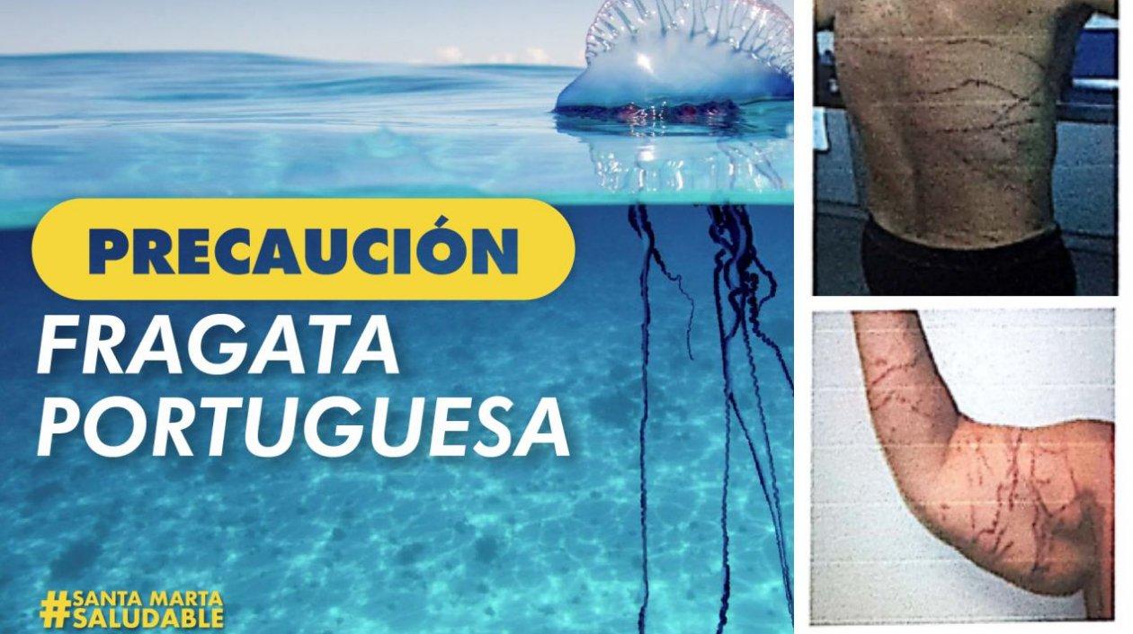 Autoridades recomiendan precaución por la medusa fragata en las playas de Santa Marta.