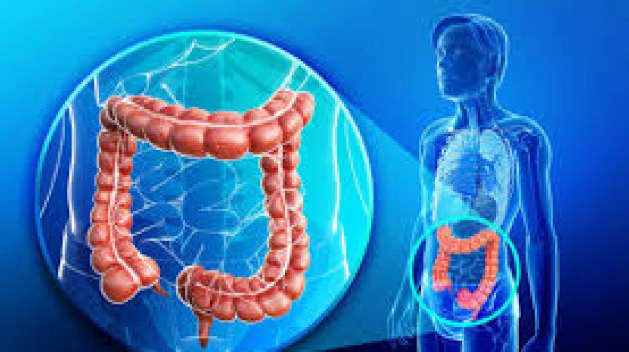 Ilustración de cáncer colorrectal