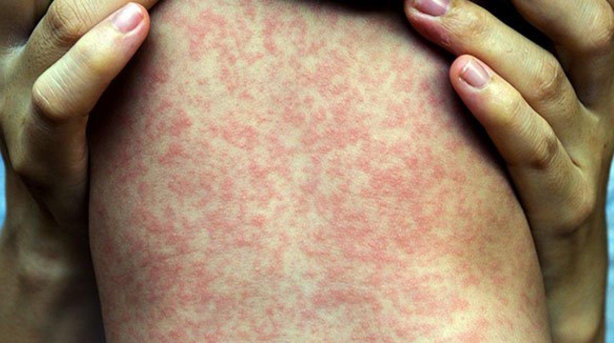 Sigue la alerta en el país por casos importados de sarampión.