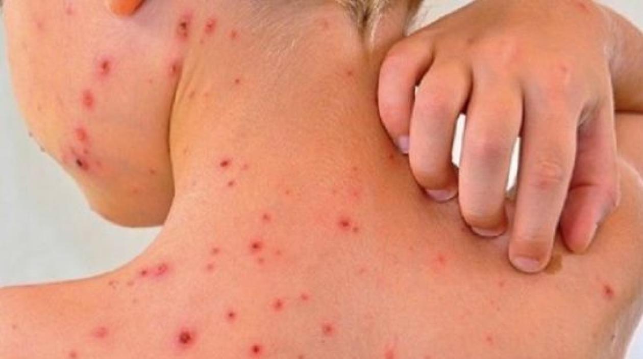 El instituto agregó que actualmente estudian 157 casos sospechosos de sarampión.