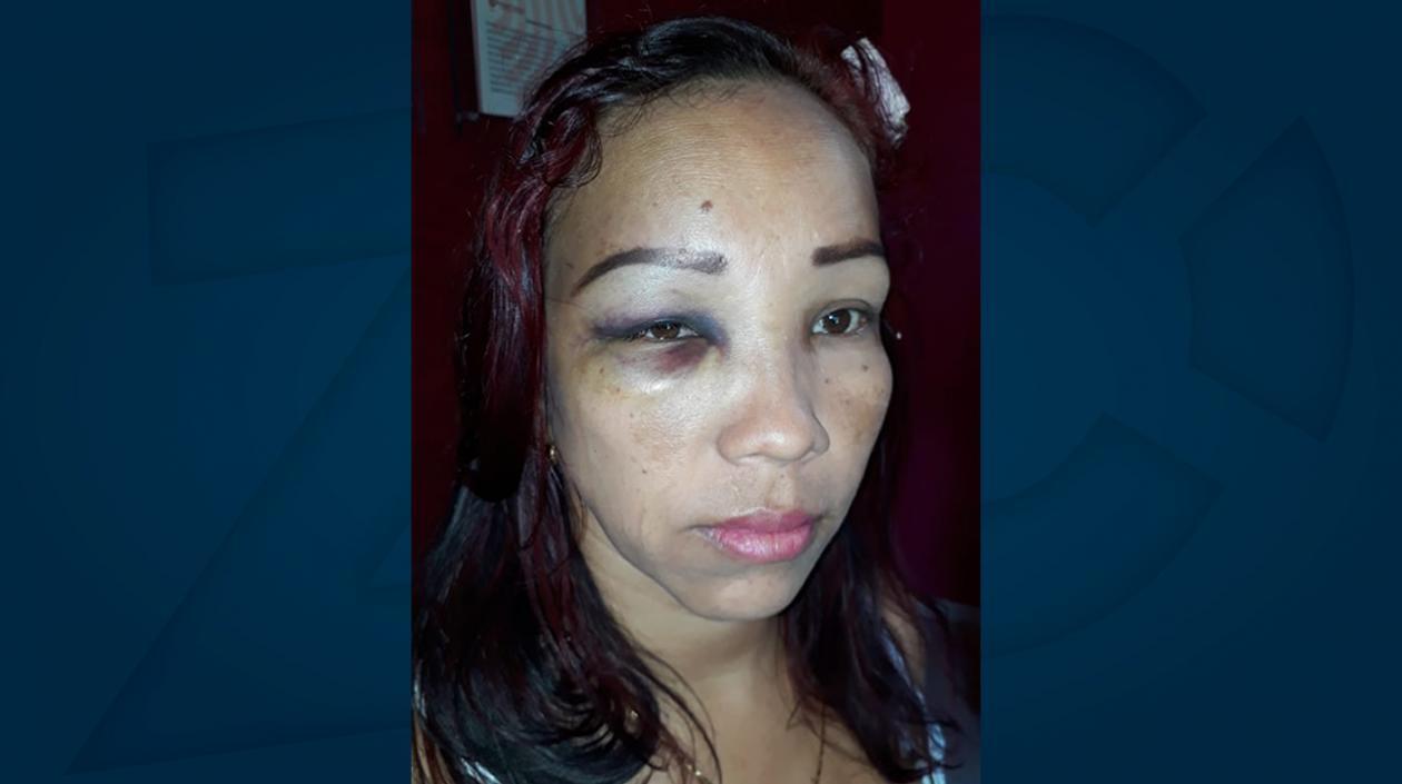 Así quedó el rostro de Cindy Anguila. La mujer autorizó a publicar la foto.