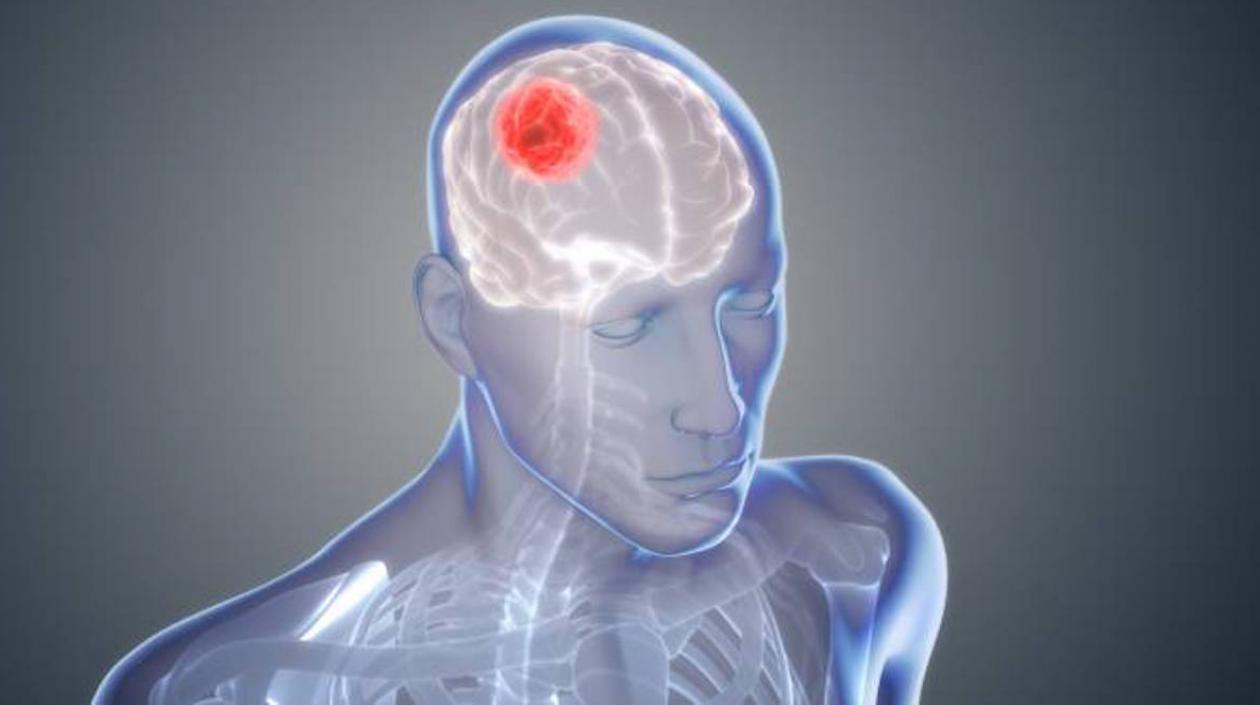 El glioblastoma es uno de los peores tumores cerebrales.