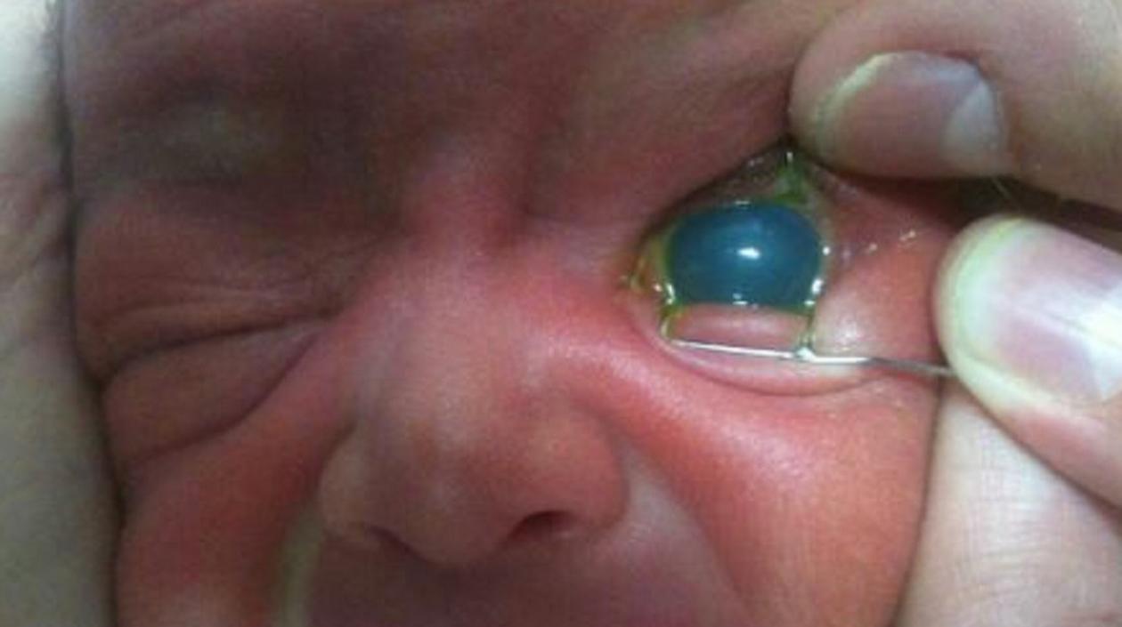 Durante el primer año de vida se llama glaucoma congénito.