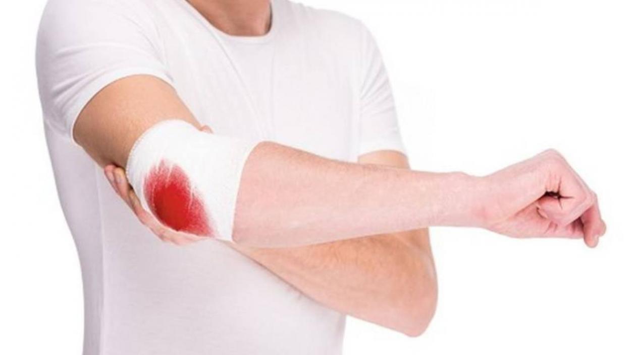 La hemofilia es una enfermedad hereditaria.