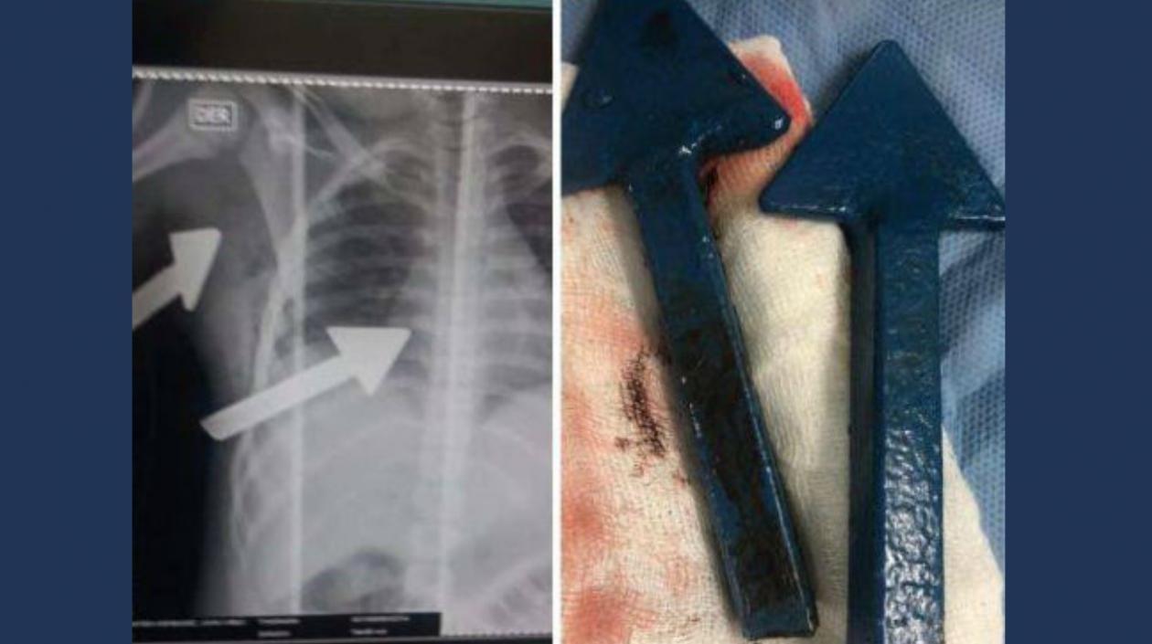 Radiografía del menor y rejas incrustadas en su cuerpo.