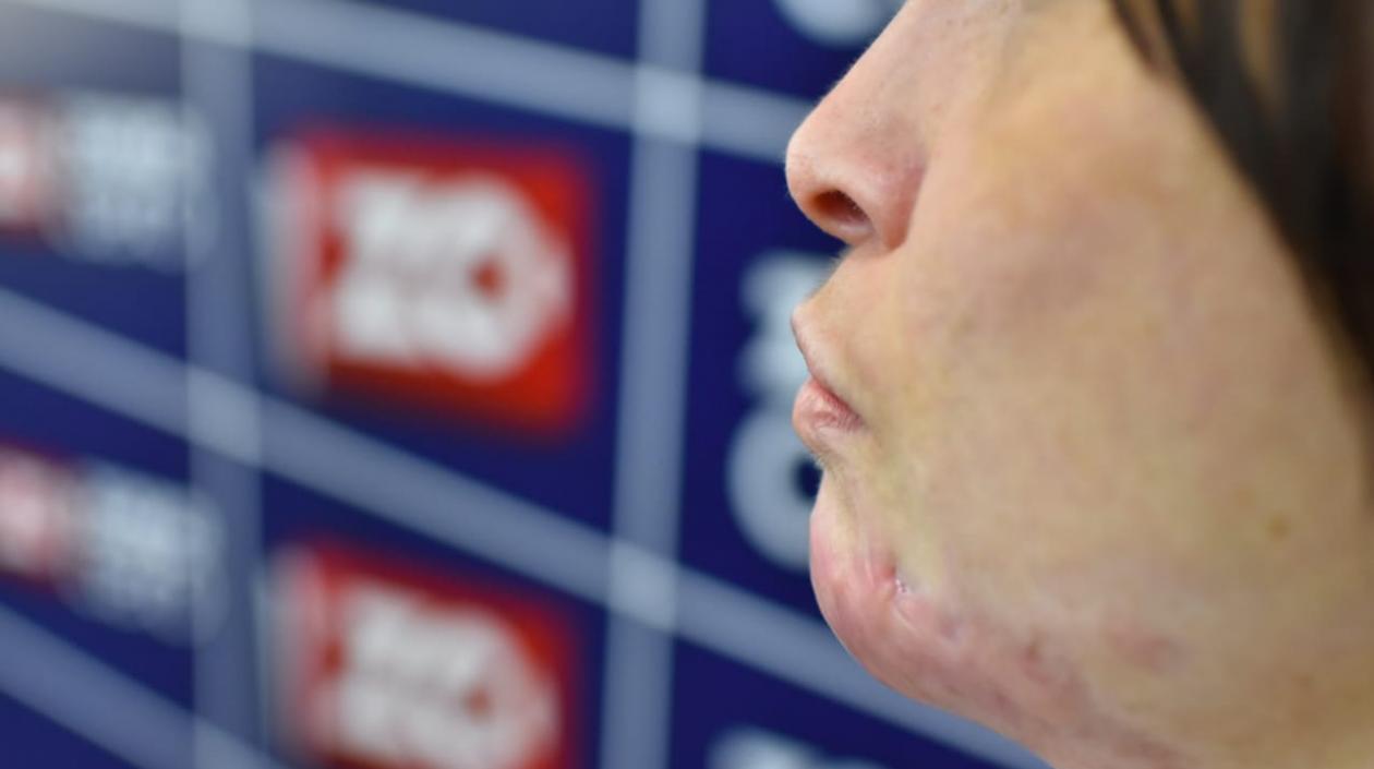 La quemadura que sufrió María Elizabeth en su mentón.