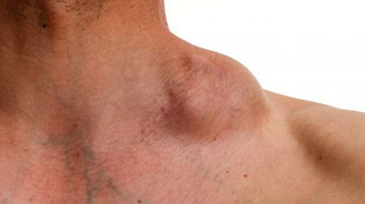  El linfoma es un cáncer que se encuentra en la sangre por ello está en todo el cuerpo y no se puede operar para contrarrestarlo como sucede en otros tipos.