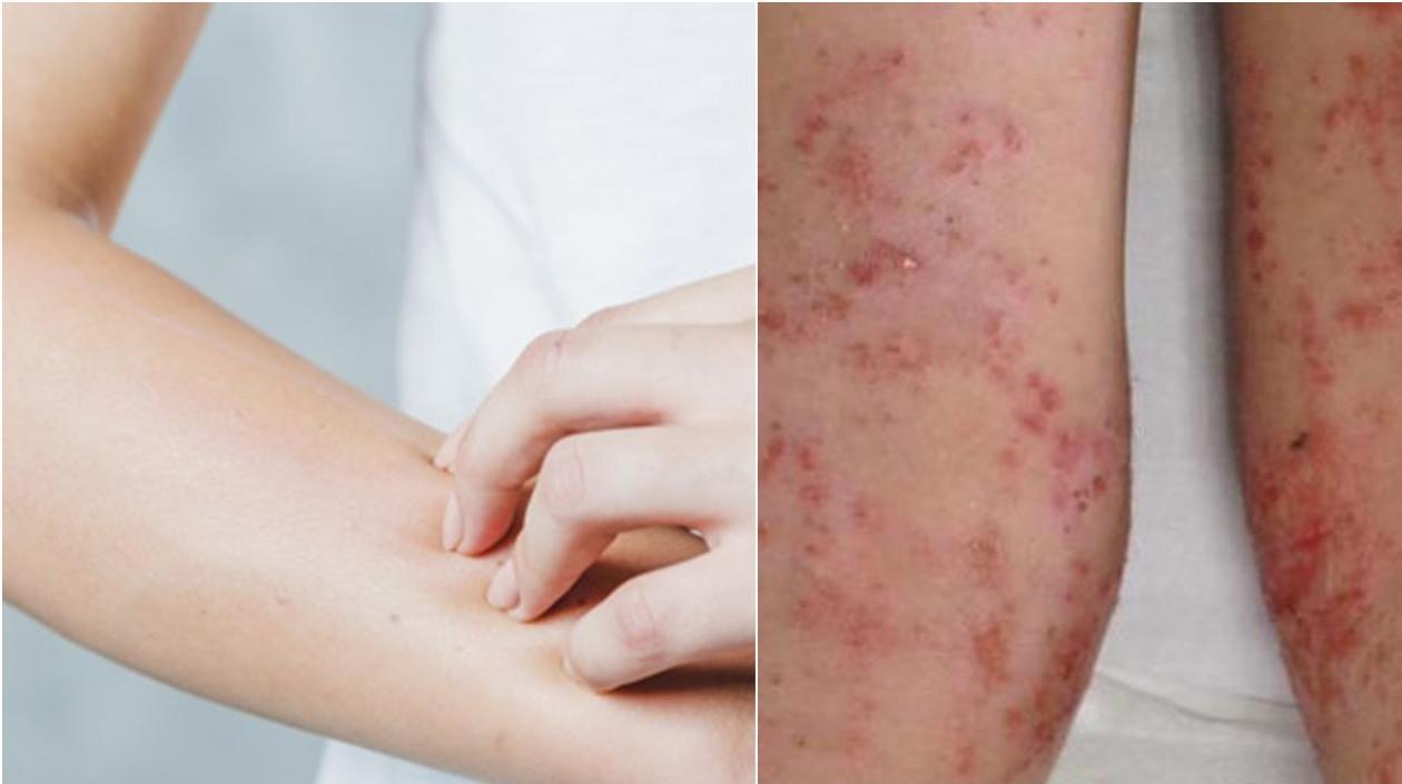 Esta enfermedad aparece desde el primer mes de vida.