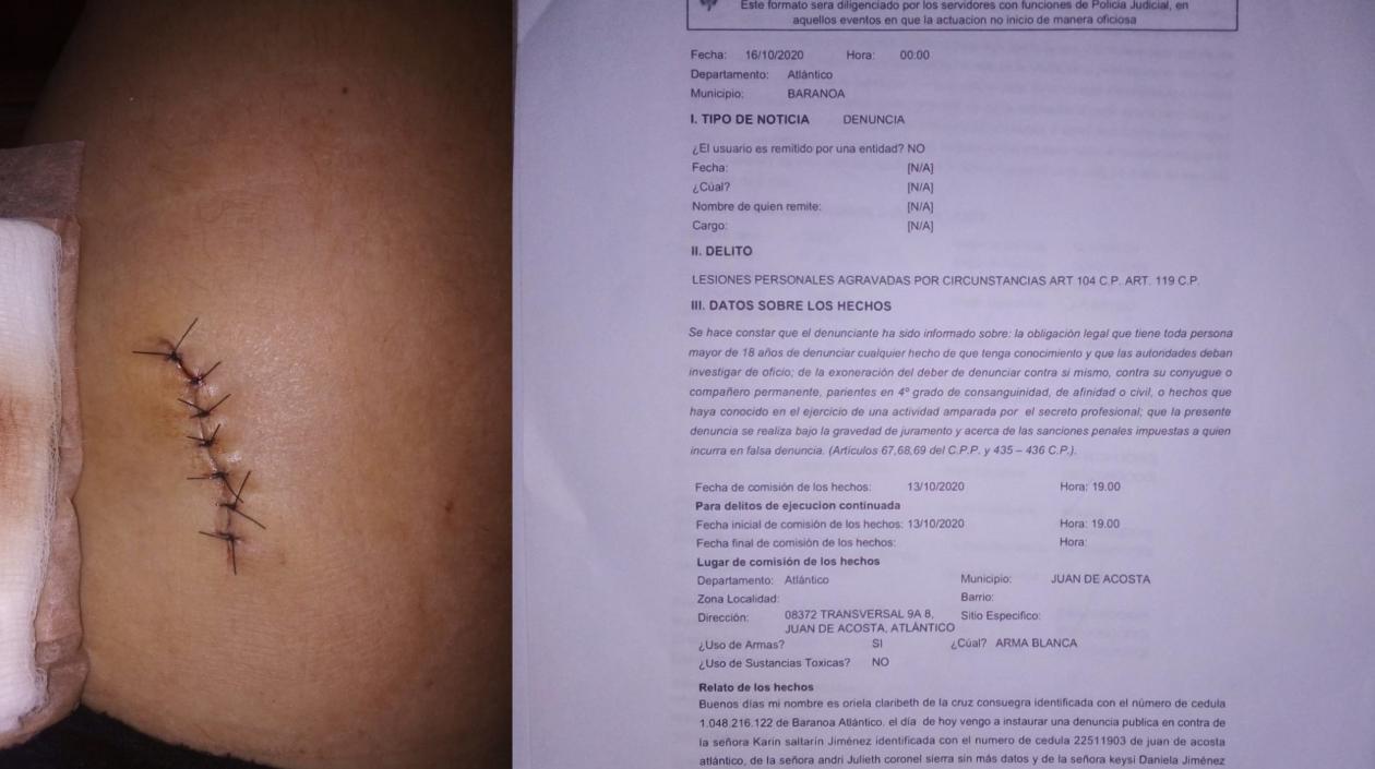 La mujer con la herida con tijera en una de sus piernas y la denuncia instaurada por ella. 