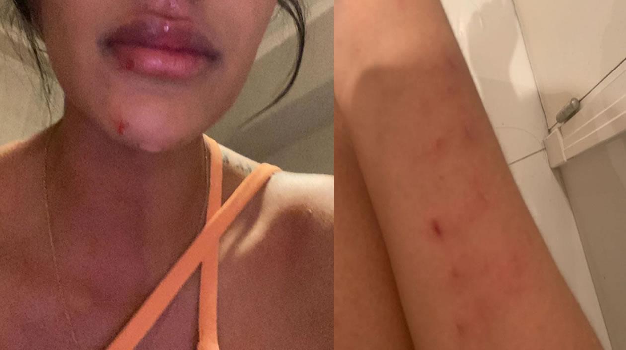 Daniela Cortés mostrando los efectos del maltrato físico.