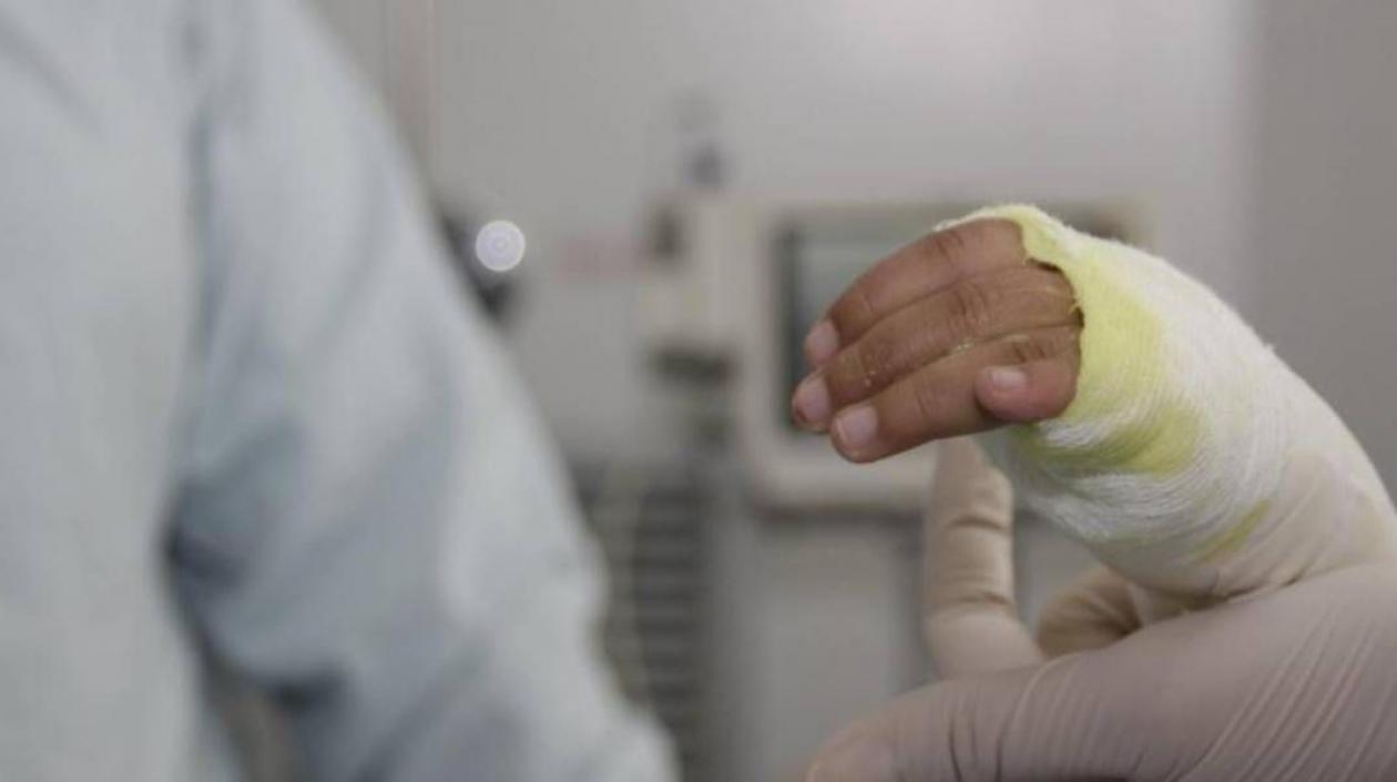 Mano de un niño quemado. 