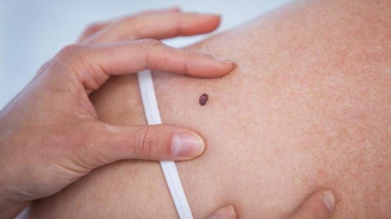 Esos "patito feo" puede acabar en melanoma.