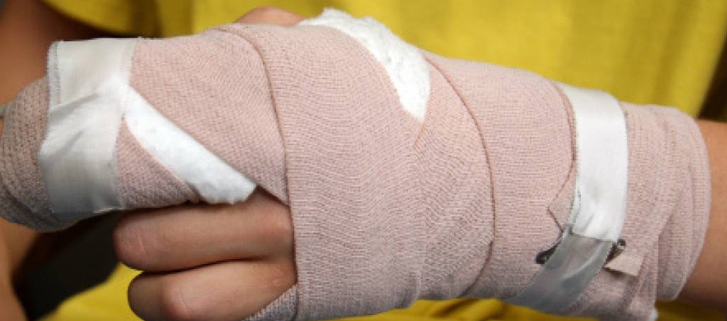 Quemado con pólvora.