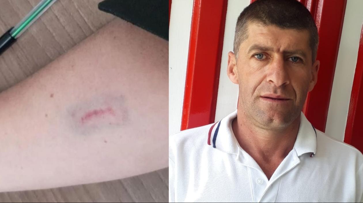 Concejal de Marulanda Alfredo Morales Llano atacó a patrullera, propinándole un mordisco.