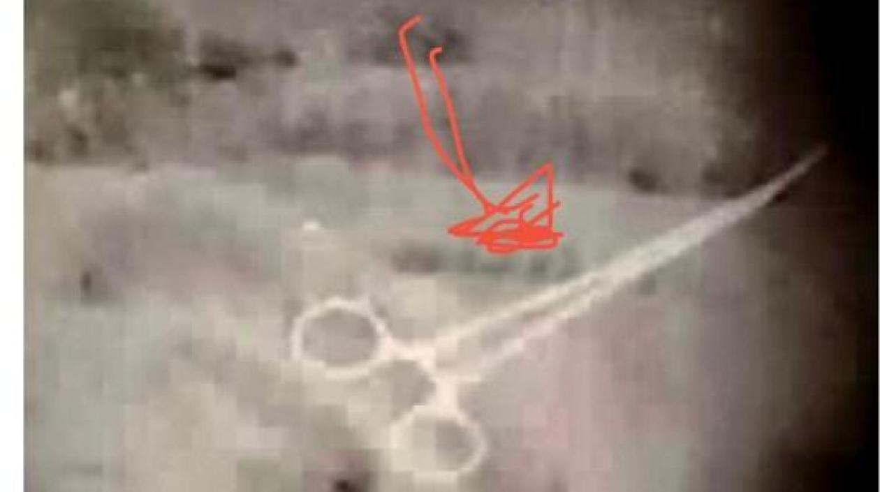 Radiografía de la pinza quirúrgica en el cuerpo del paciente.