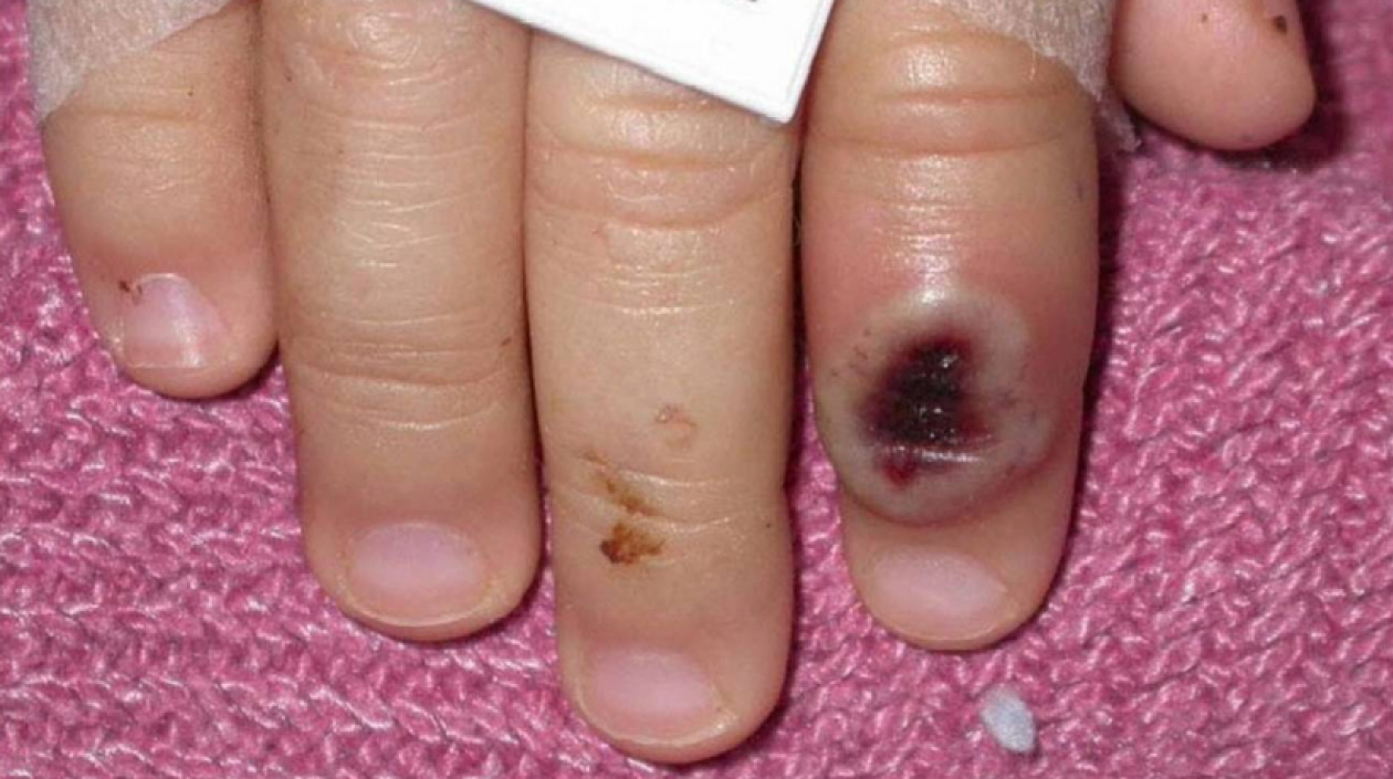 Dedo de un niño infectado por la llamada viruela de mono.