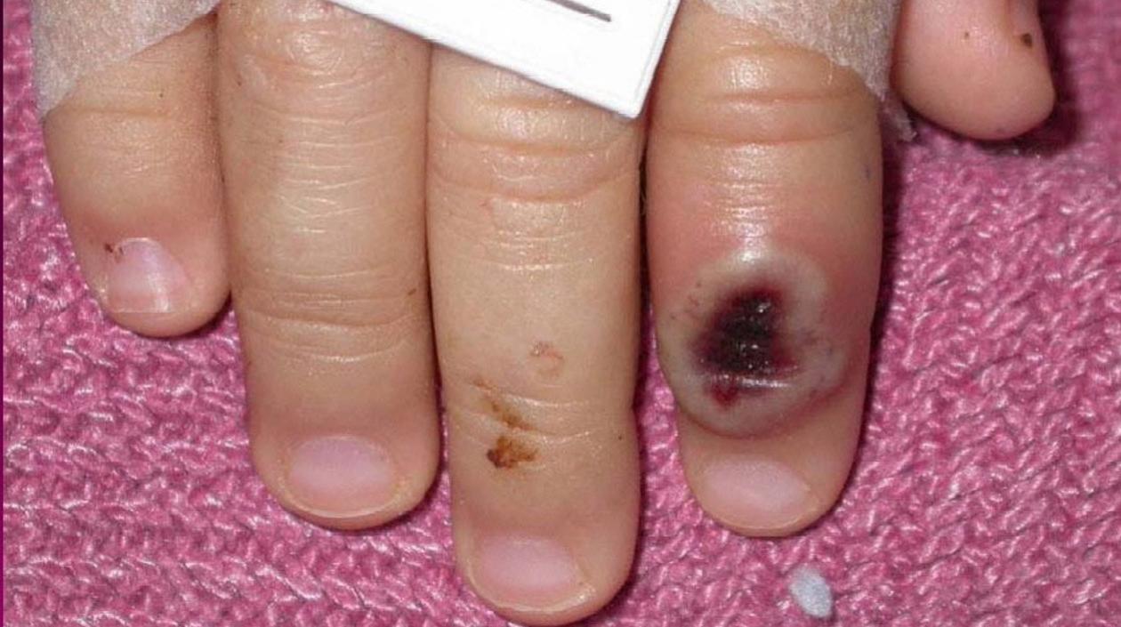 Paciente pediátrico de viruela del mono.