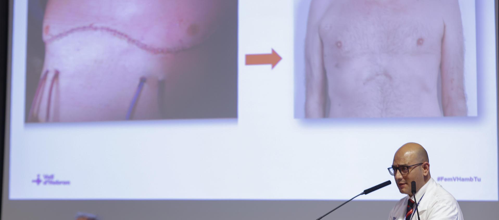 Todo un éxito el primer transplante pulmonar robótico 