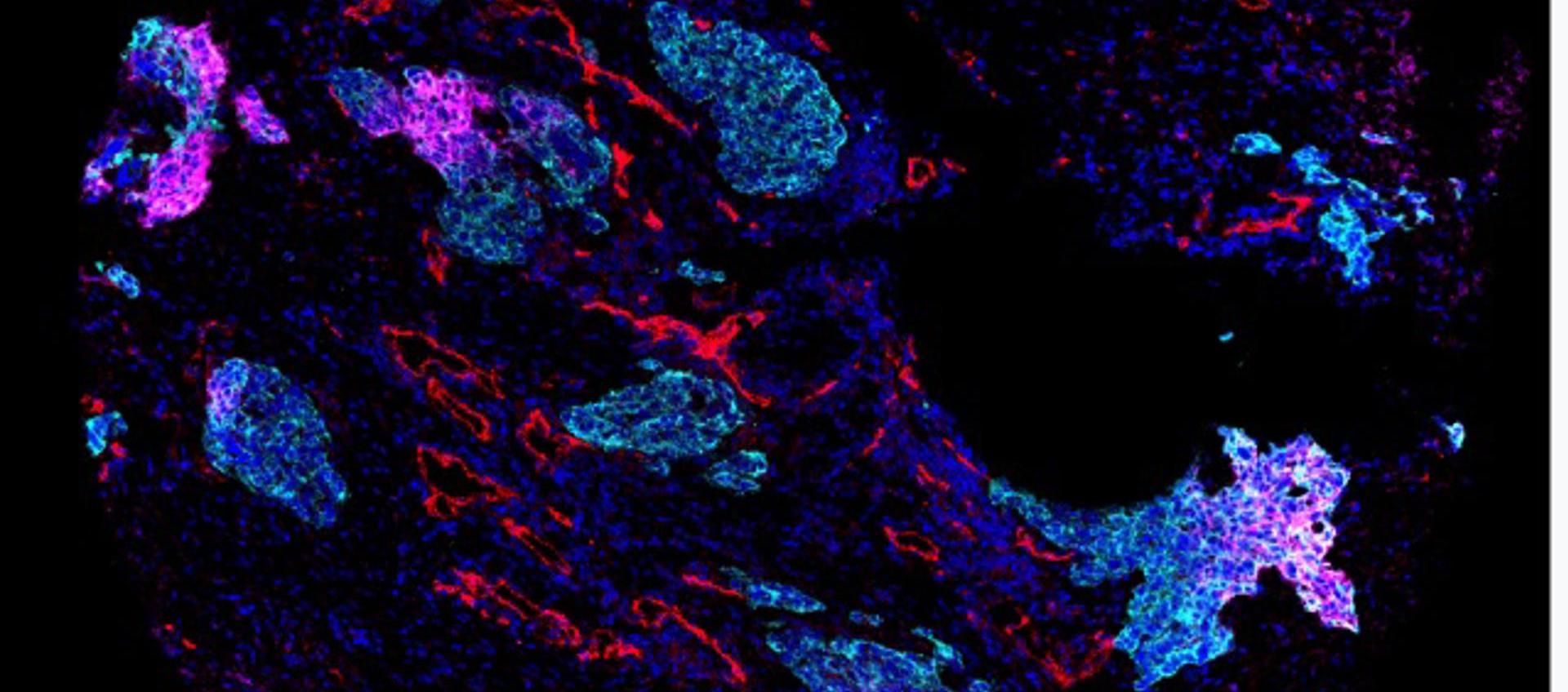 Imagen cedida de células tumorales de cáncer de pulmón