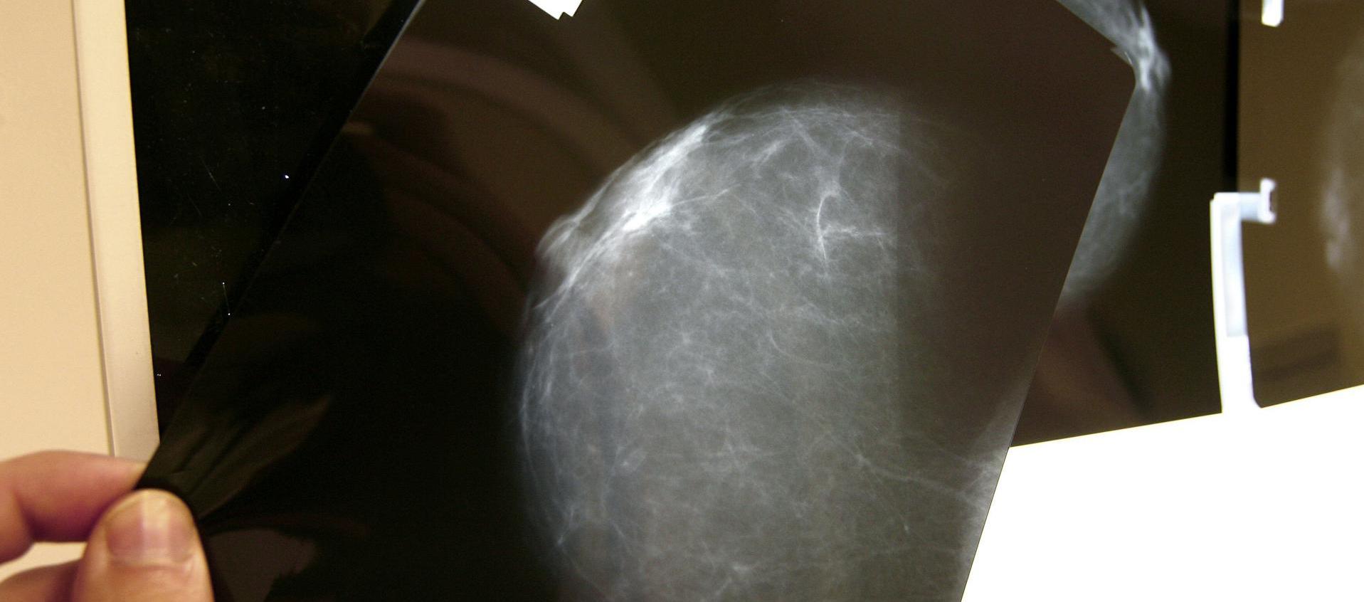 Fotografía de archivo de una prueba radiológica de mama.