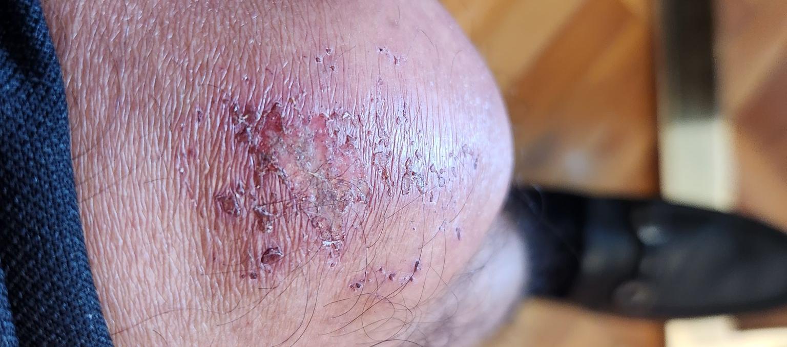 Así quedó la rodilla del Presidente Gustavo Petro.