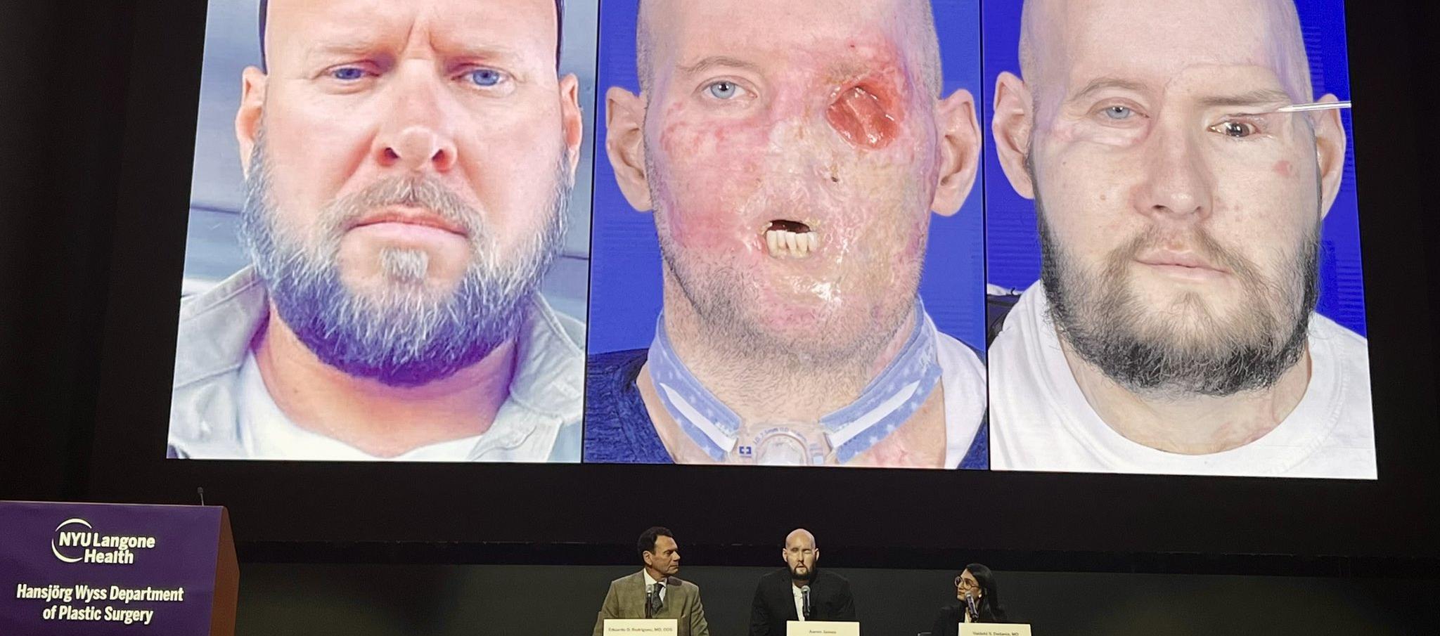 Combinaron el ojo del donante con células madre derivadas de la médula ósea del paciente.