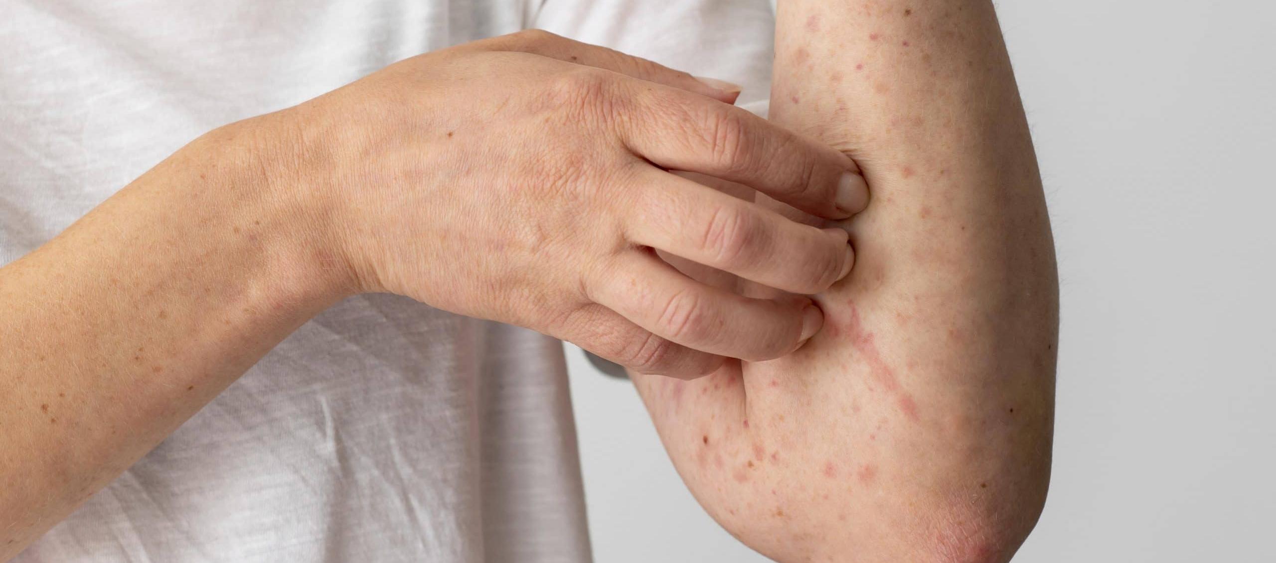 Imagen de referencia de la viruela del mono.