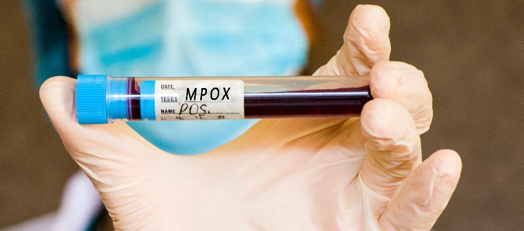 Prueba de sangre para detectar Mpox.