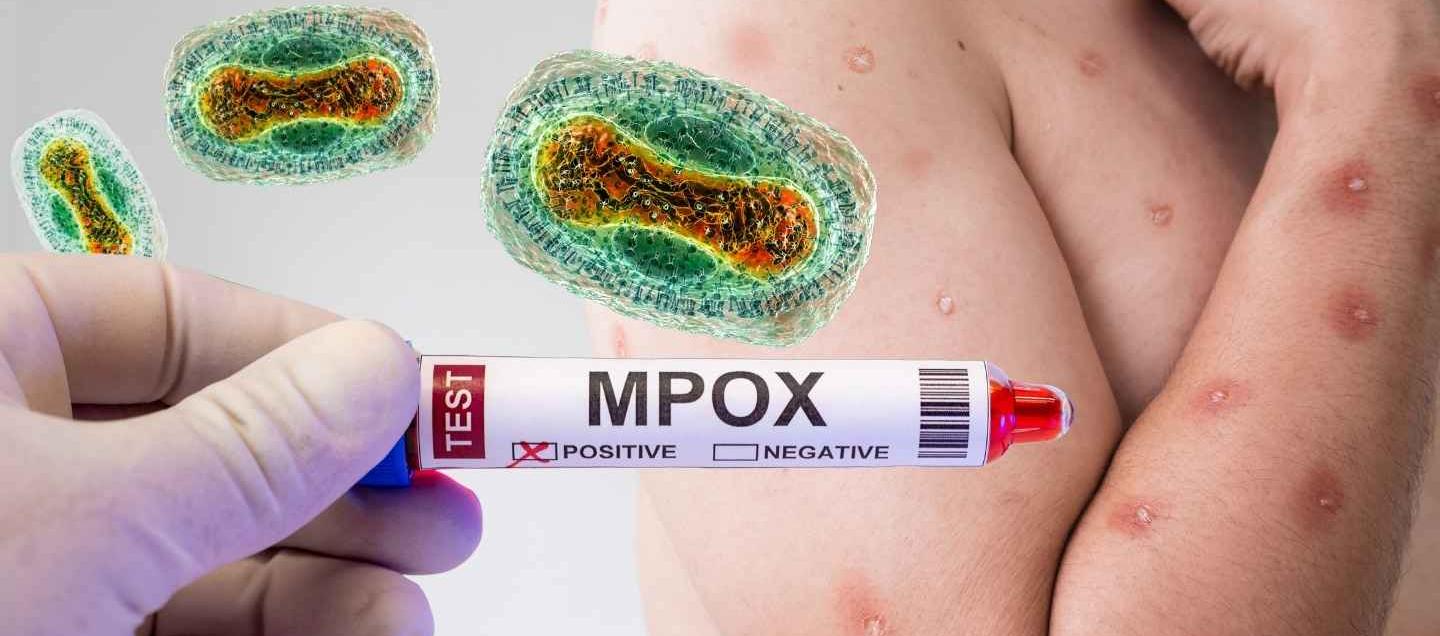 Mpox. 