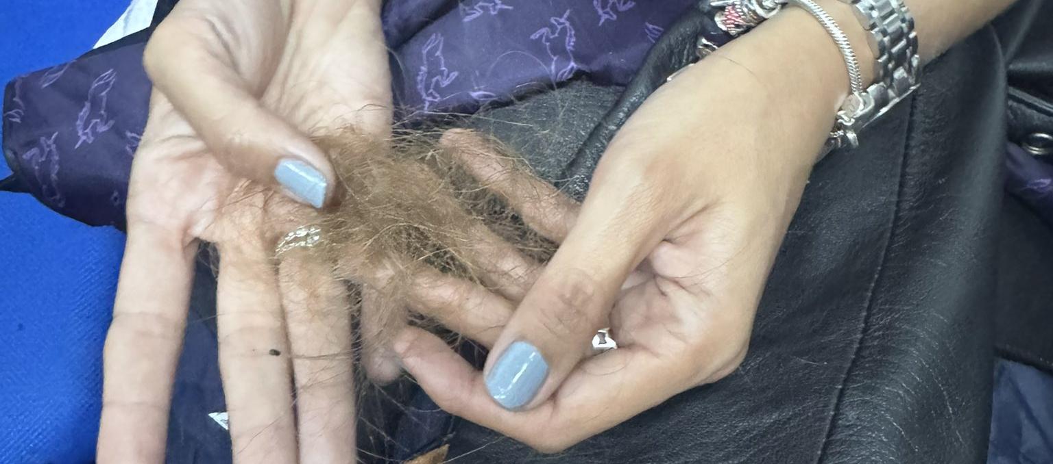 Resultaron con quemaduras en la piel, las manos y el cabello. 