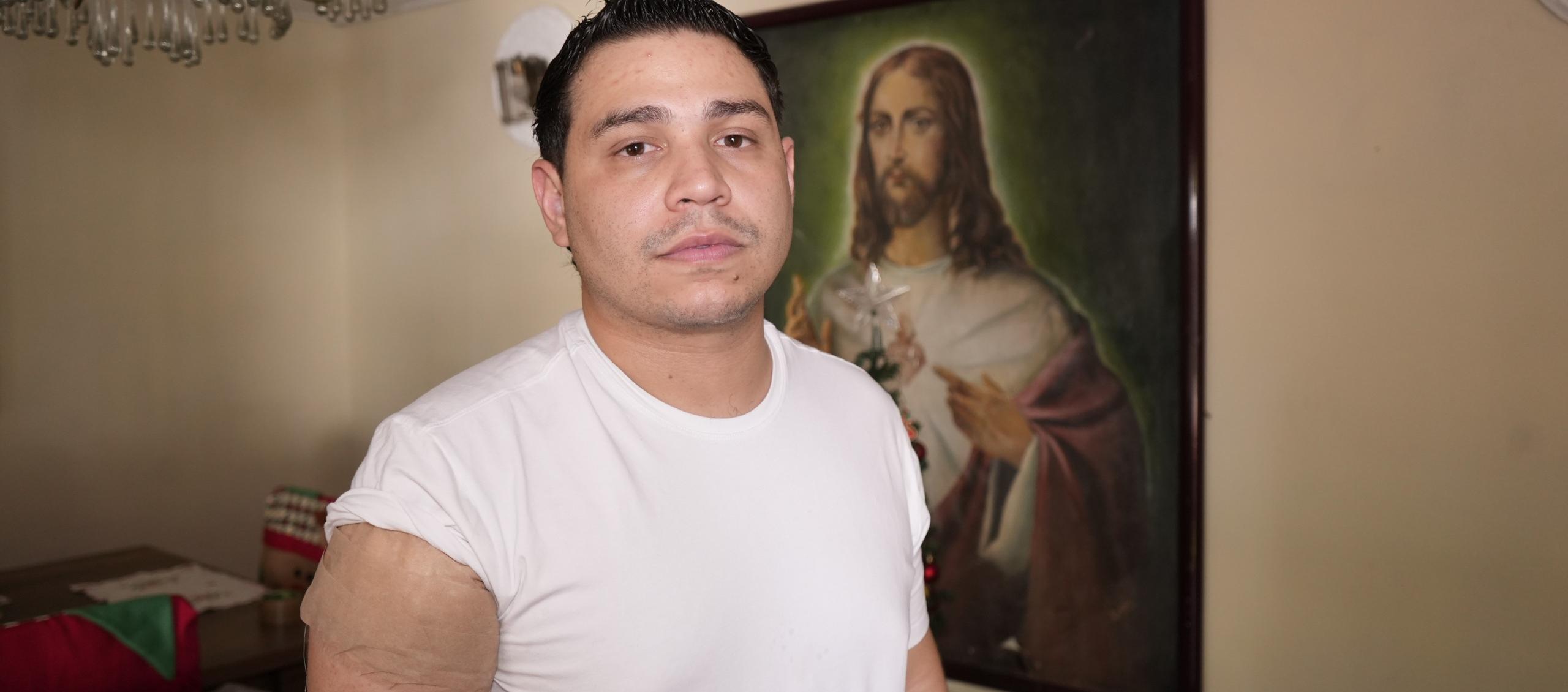 El artista guajiro muestra donde resultó herido en su brazo derecho. 