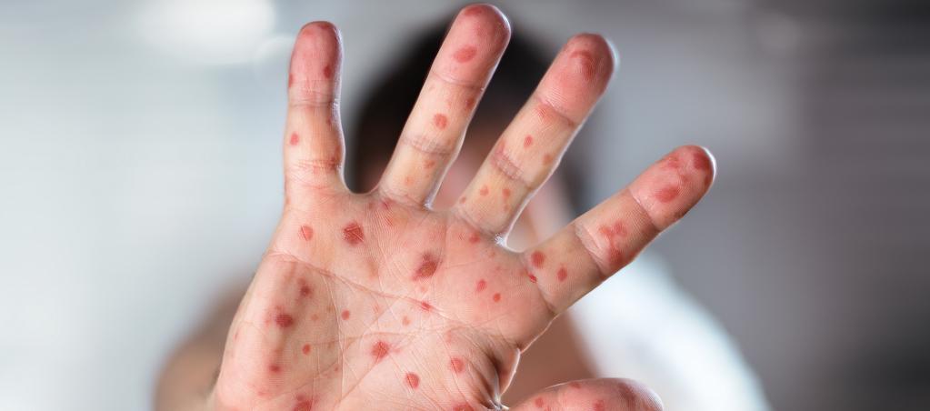 Imagen de referencia de sarampión.