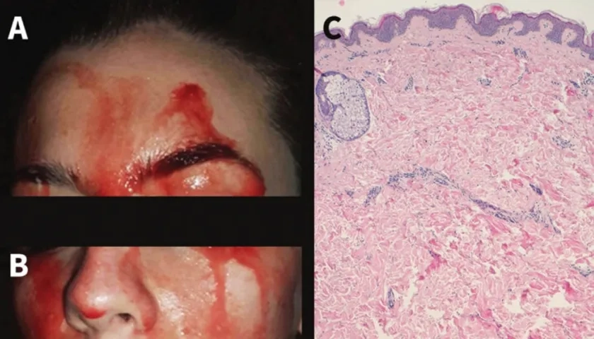 Joven italiana que suda sangre por las manos y cara