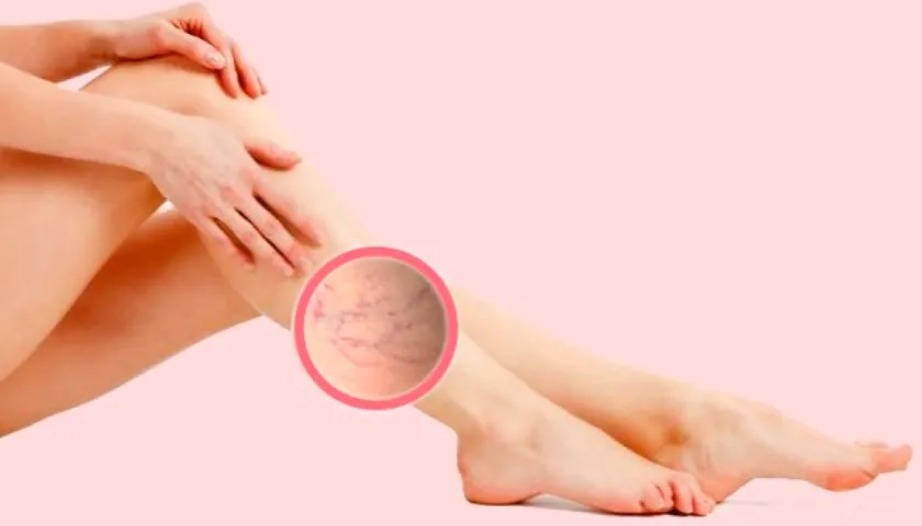 Ilustración várices