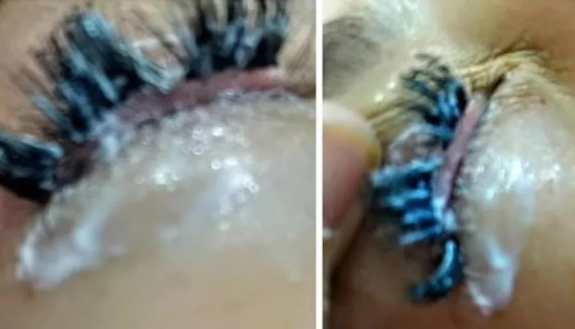 Mujer afectada por goma tóxica en sus pestañas.