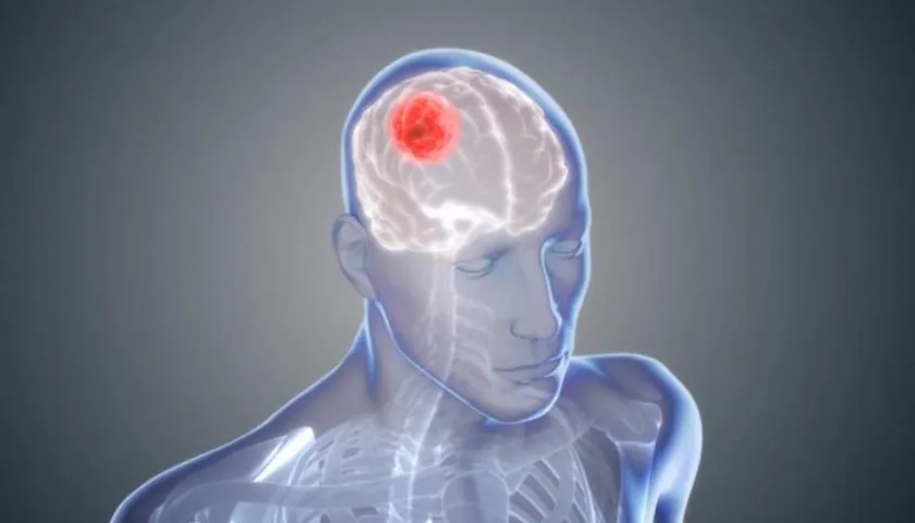 El glioblastoma es uno de los peores tumores cerebrales.