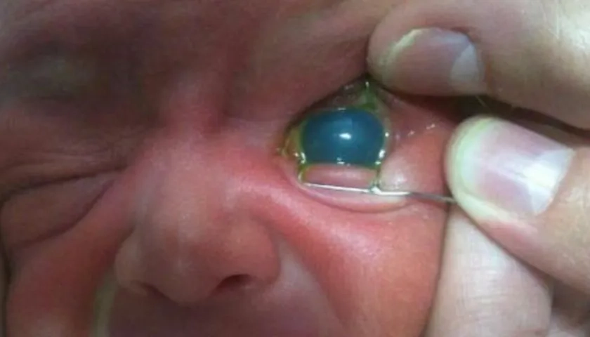 Durante el primer año de vida se llama glaucoma congénito.