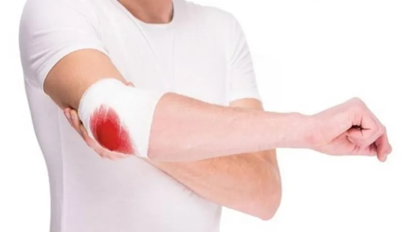 La hemofilia es una enfermedad hereditaria.