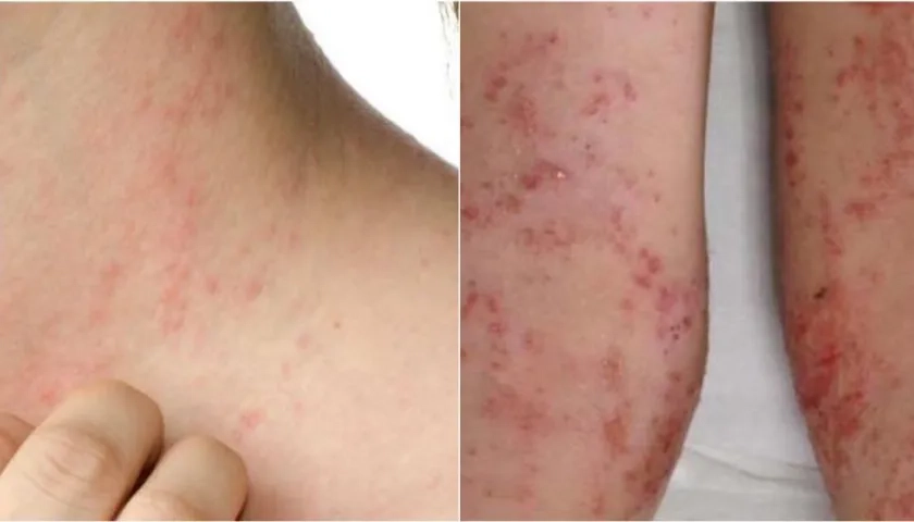 Esta enfermedad aparece desde el primer mes de vida.